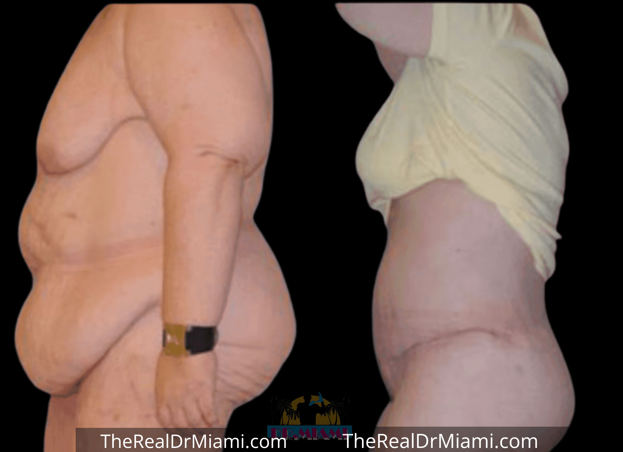 Before-and-after views for Tummy Tuck, Case 59.