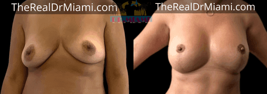 Before-and-after views for Breast Lift, Case 58.
