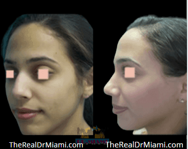 Before-and-after views for Rhinoplasty, Case 64.