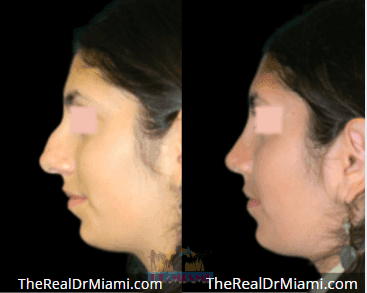 Before-and-after views for Rhinoplasty, Case 73.
