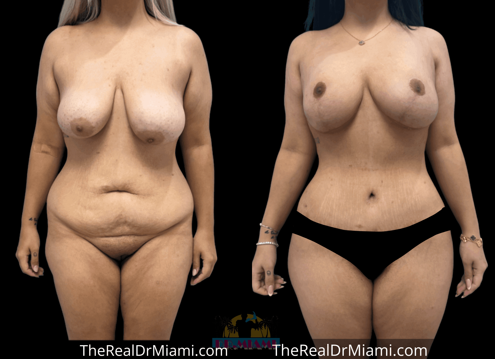 Before-and-after views for Mommy Makeover, Case 105.