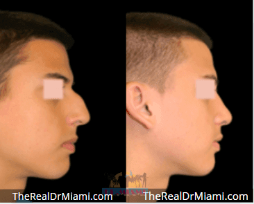 Before-and-after views for Rhinoplasty, Case 105.