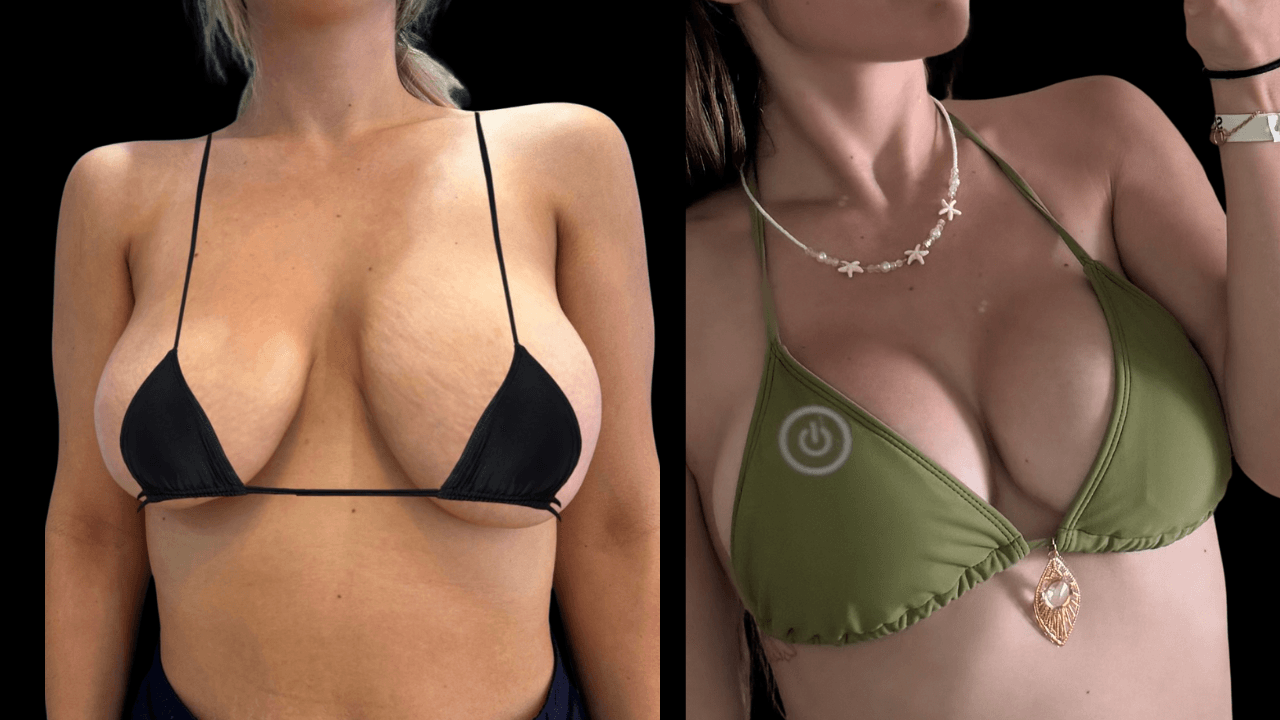 Before-and-after views for Breast Augmentation / Lift, Case 13 from The Next Dr. Miami collection.