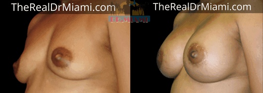 Before-and-after views for Breast Lift, Case 38.