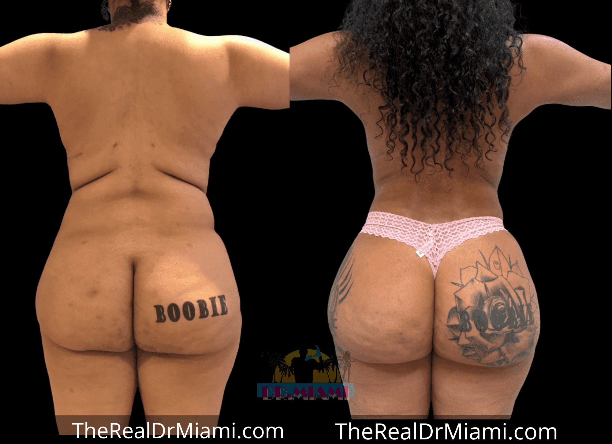Before-and-after views for Brazilian Butt Lift, Case 110.