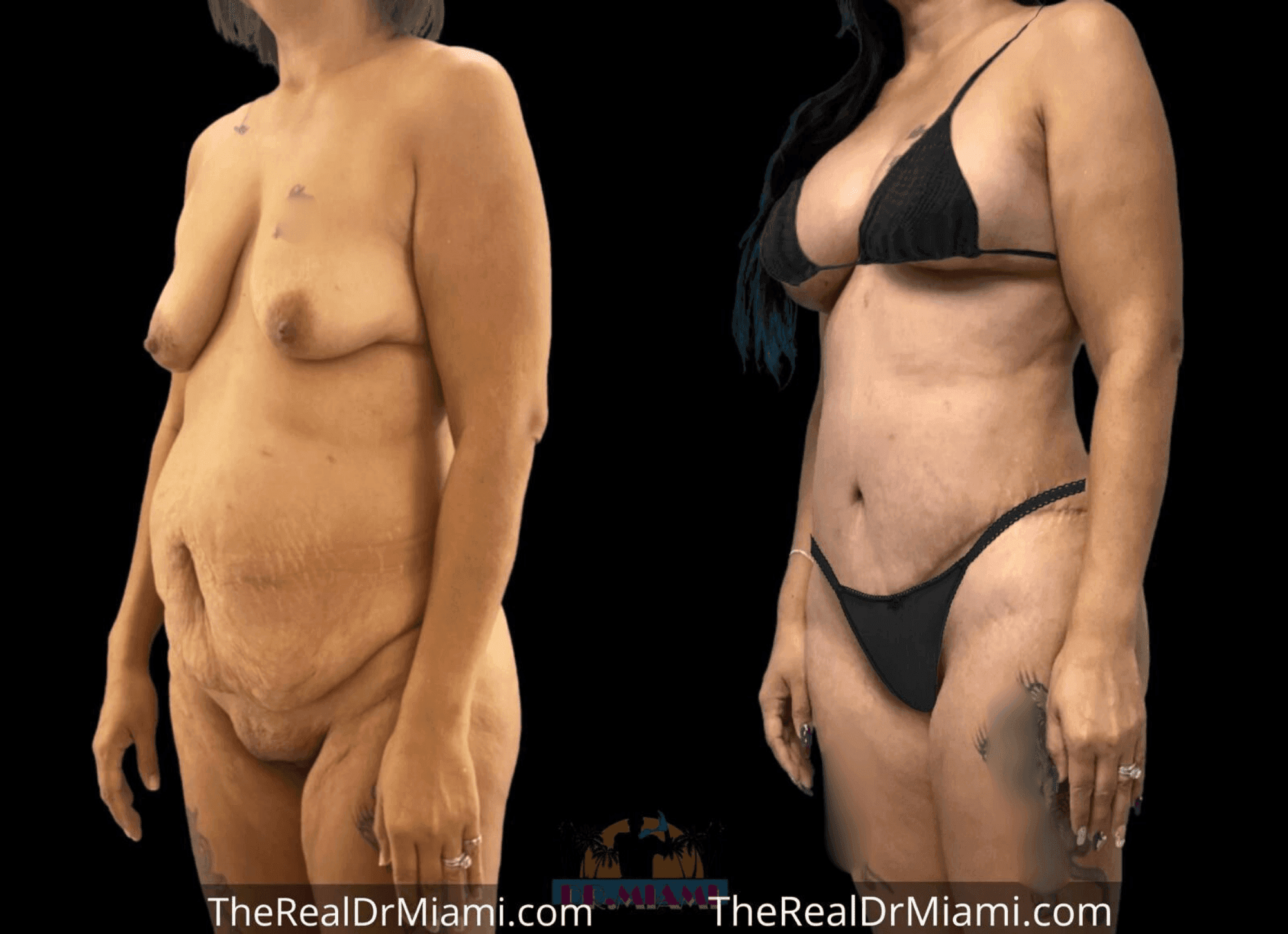 Before-and-after views for Mommy Makeover, Case 70.