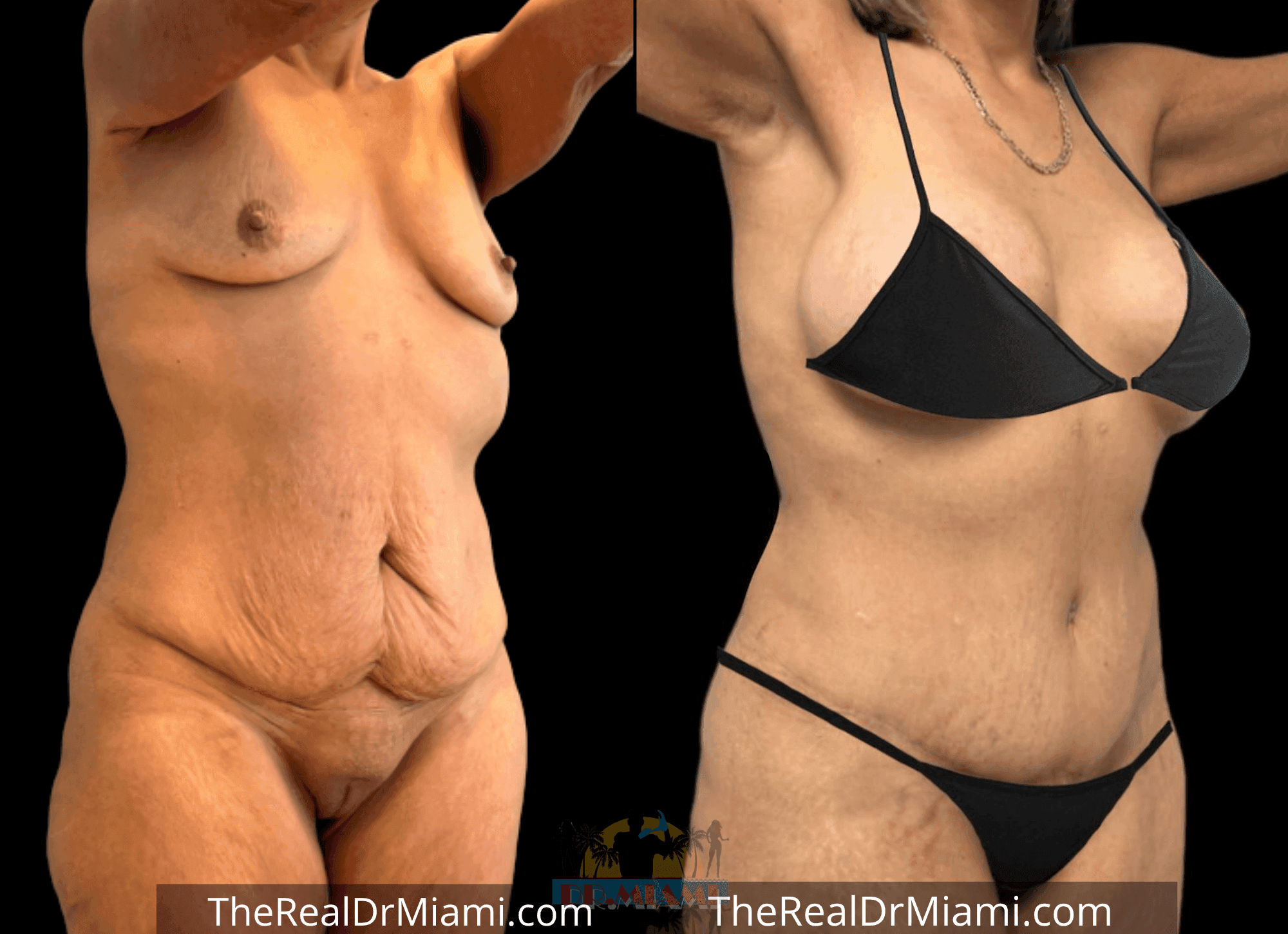 Before-and-after views for Tummy Tuck, Case 23.