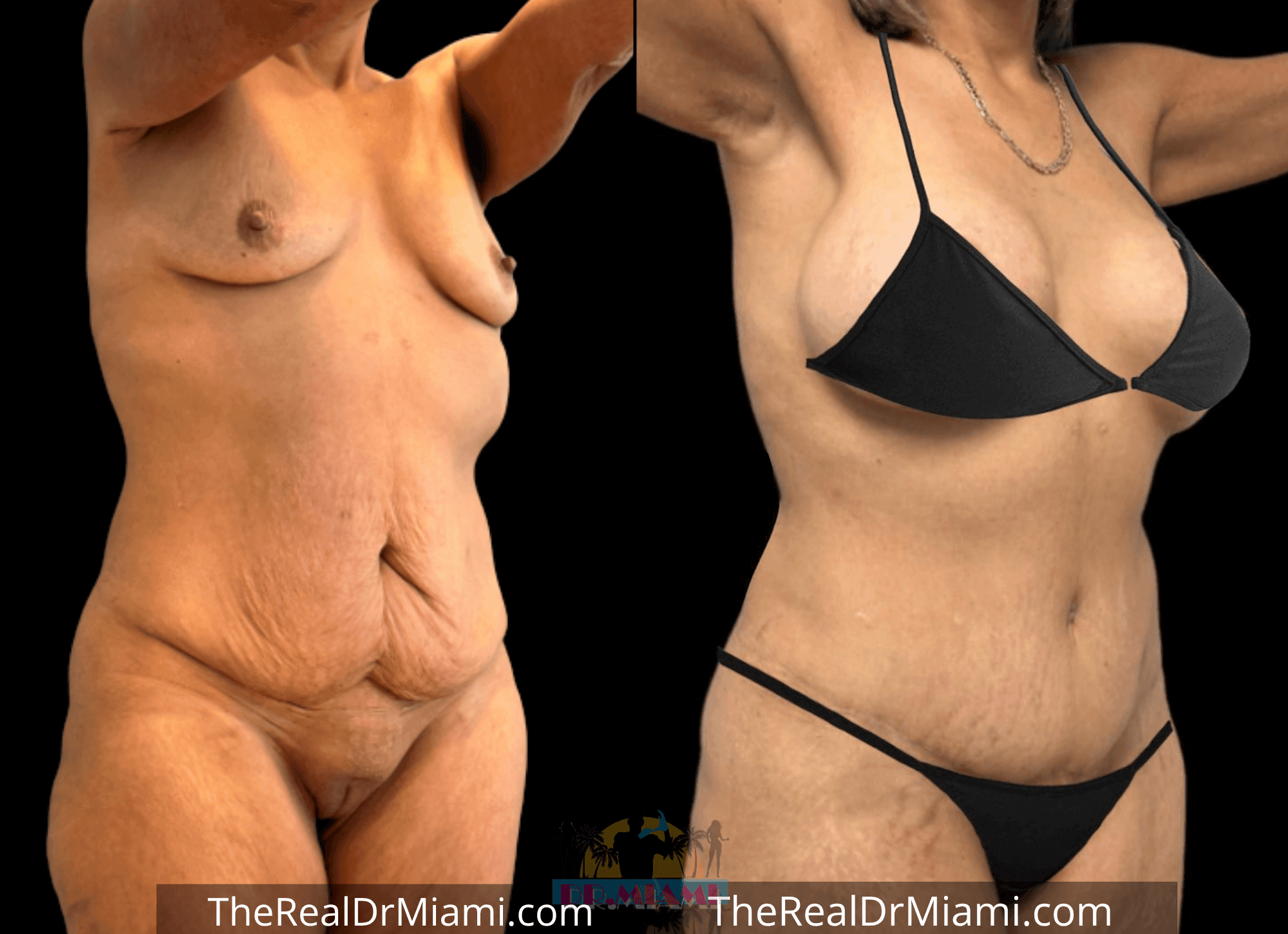 Before-and-after views for Tummy Tuck, Case 23.