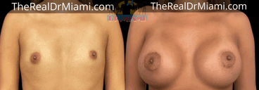 Before-and-after views for Breast Augmentation, Case 65.