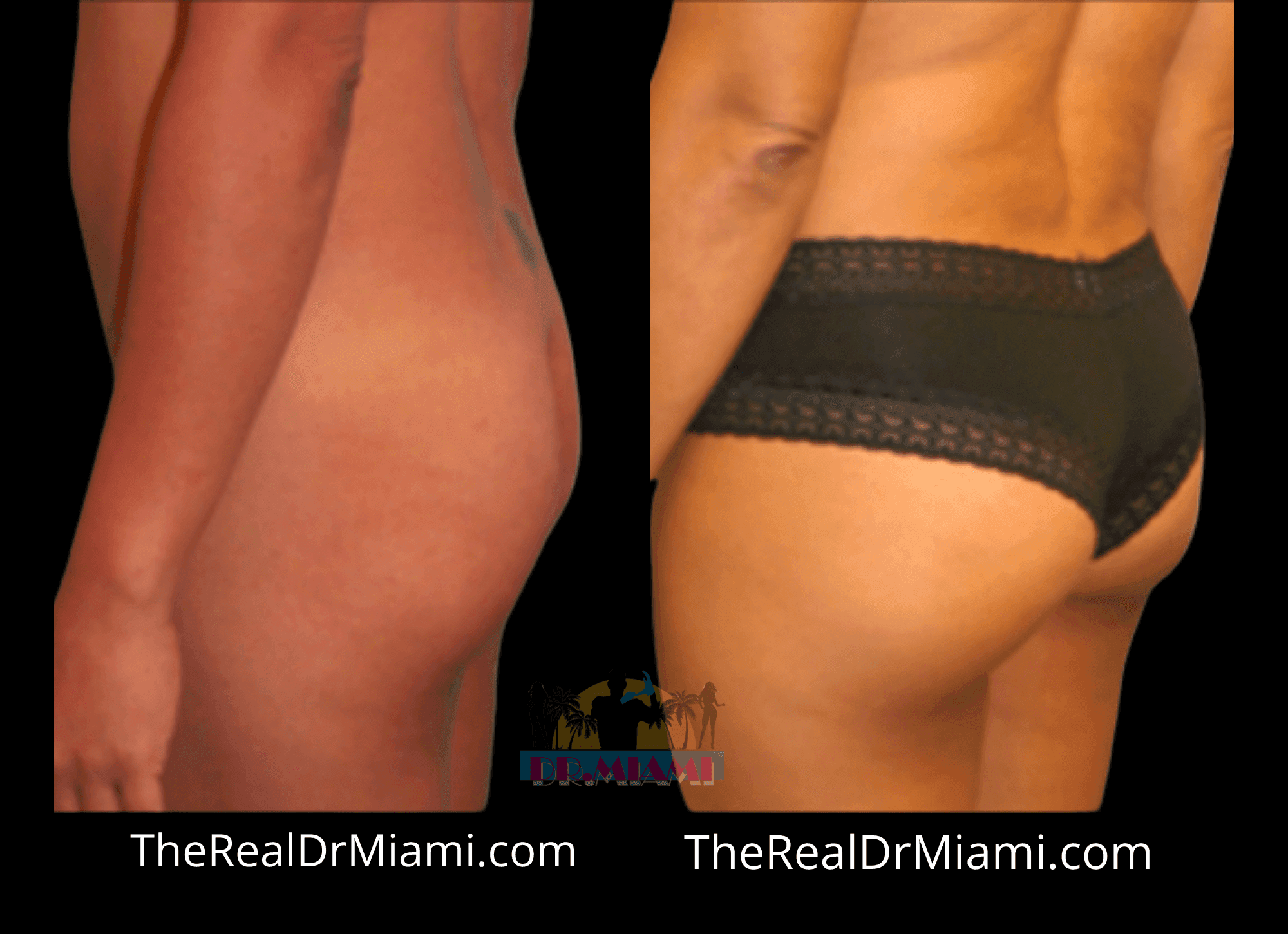 Before-and-after views for Brazilian Butt Lift, Case 46.