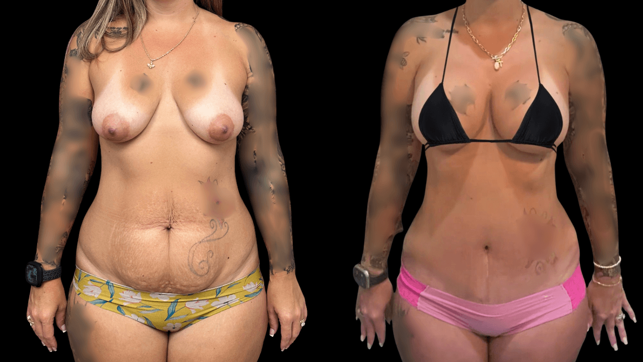 Before-and-after views for Mommy Makeover, Case 5 from The Next Dr. Miami collection.