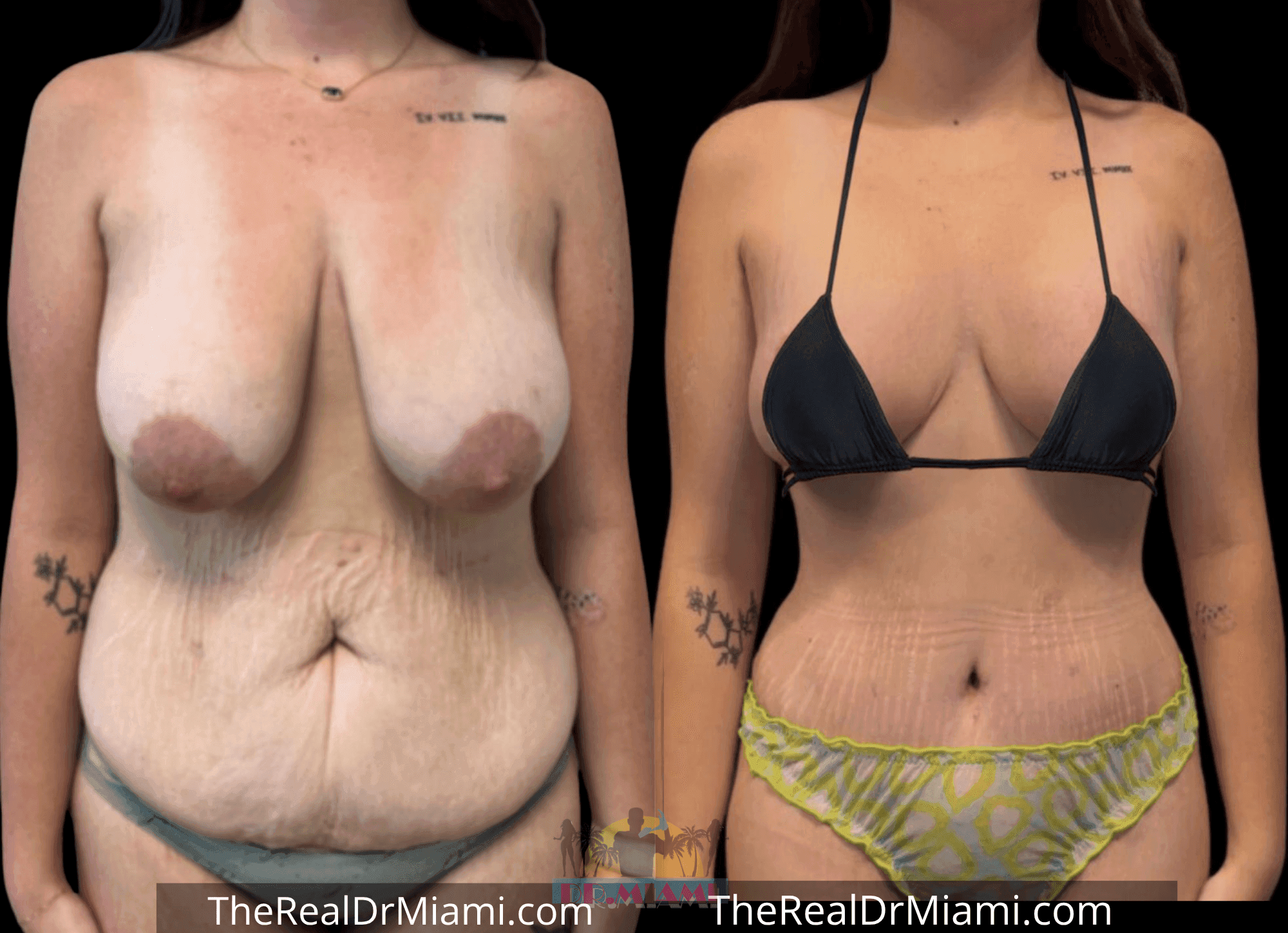 Before-and-after views for Tummy Tuck, Case 54.