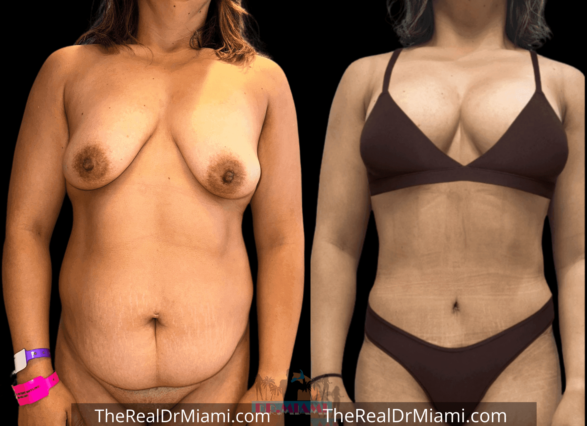 Before-and-after views for Mommy Makeover, Case 83.