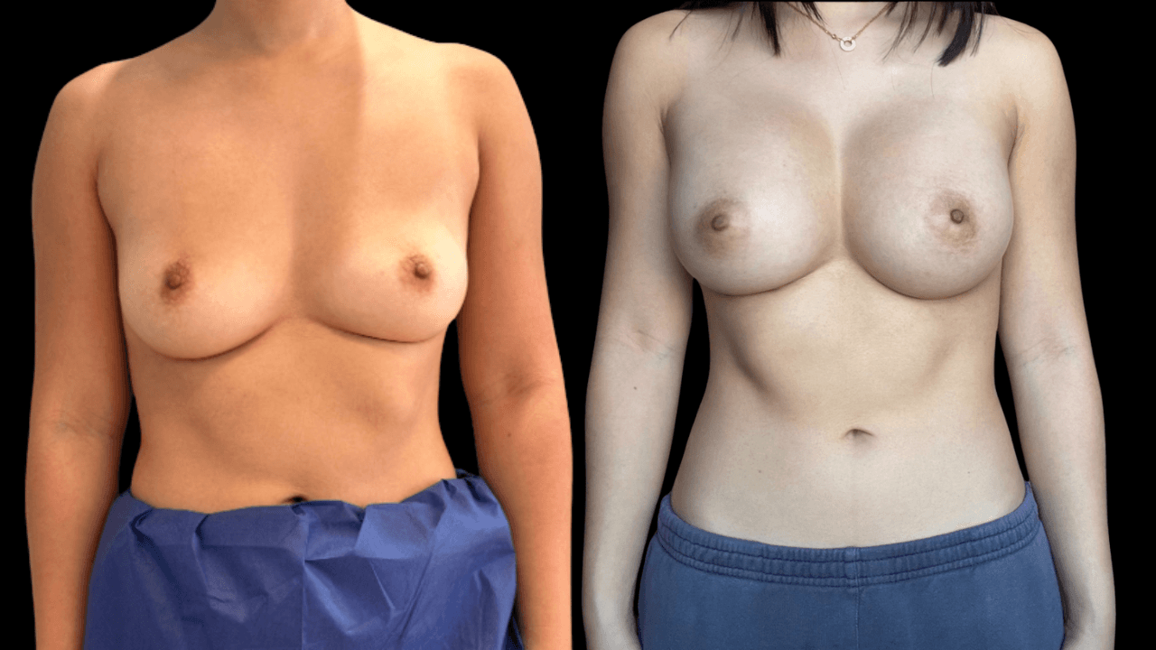 Before-and-after views for Breast Augmentation / Lift, Case 6 from The Next Dr. Miami collection.