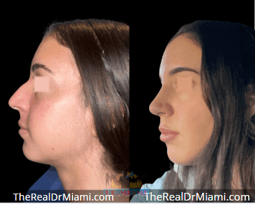 Before-and-after views for Rhinoplasty, Case 117.