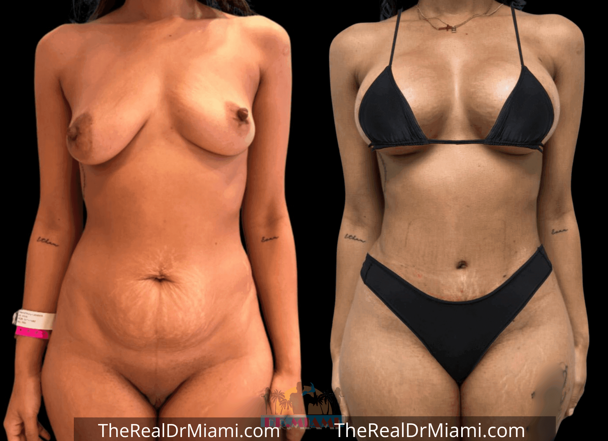 Before-and-after views for Mommy Makeover, Case 102.