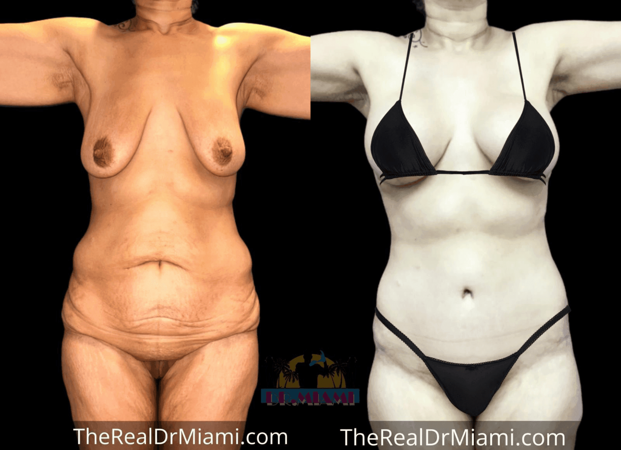 Before-and-after views for Mommy Makeover, Case 30.