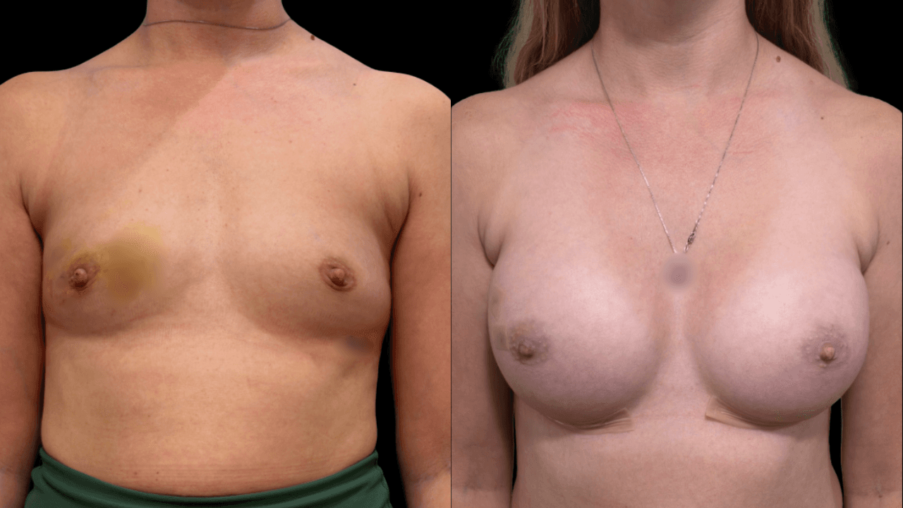 Before-and-after views for Breast Augmentation / Lift, Case 15 from The Next Dr. Miami collection.