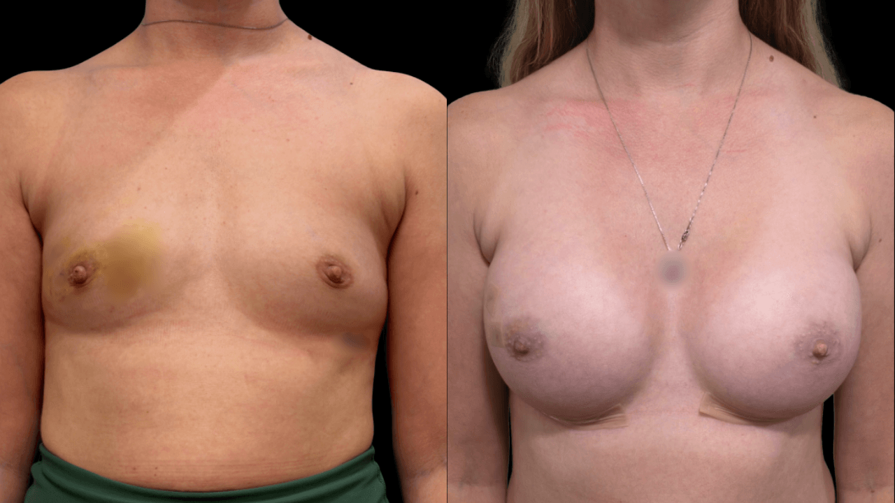 Before-and-after views for Breast Augmentation / Lift, Case 15 from The Next Dr. Miami collection.