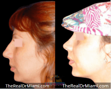 Before-and-after views for Rhinoplasty, Case 71.