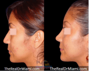 Before-and-after views for Rhinoplasty, Case 69.