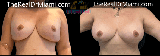 Before-and-after views for Breast Lift, Case 93.