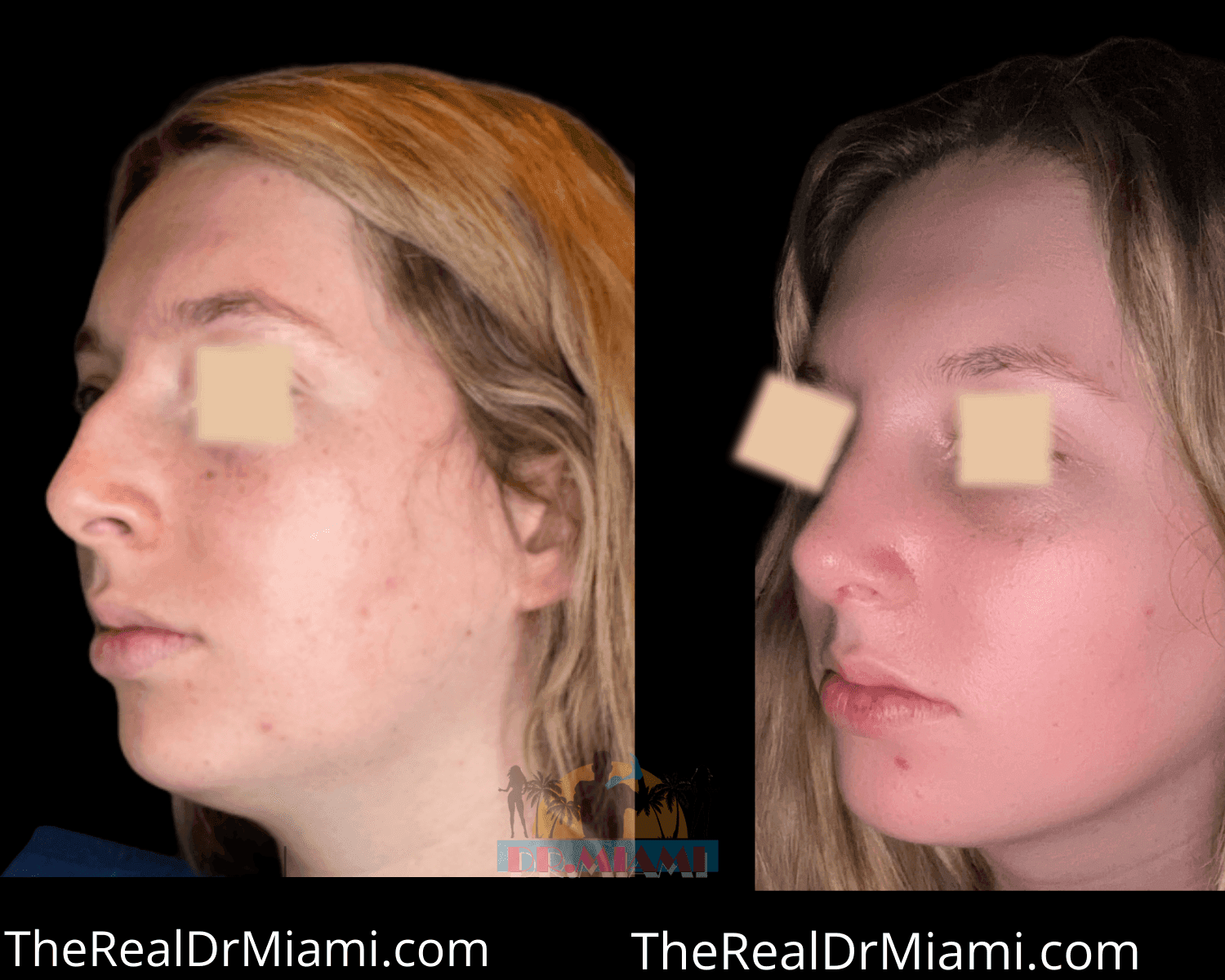Before-and-after views for Rhinoplasty, Case 43.