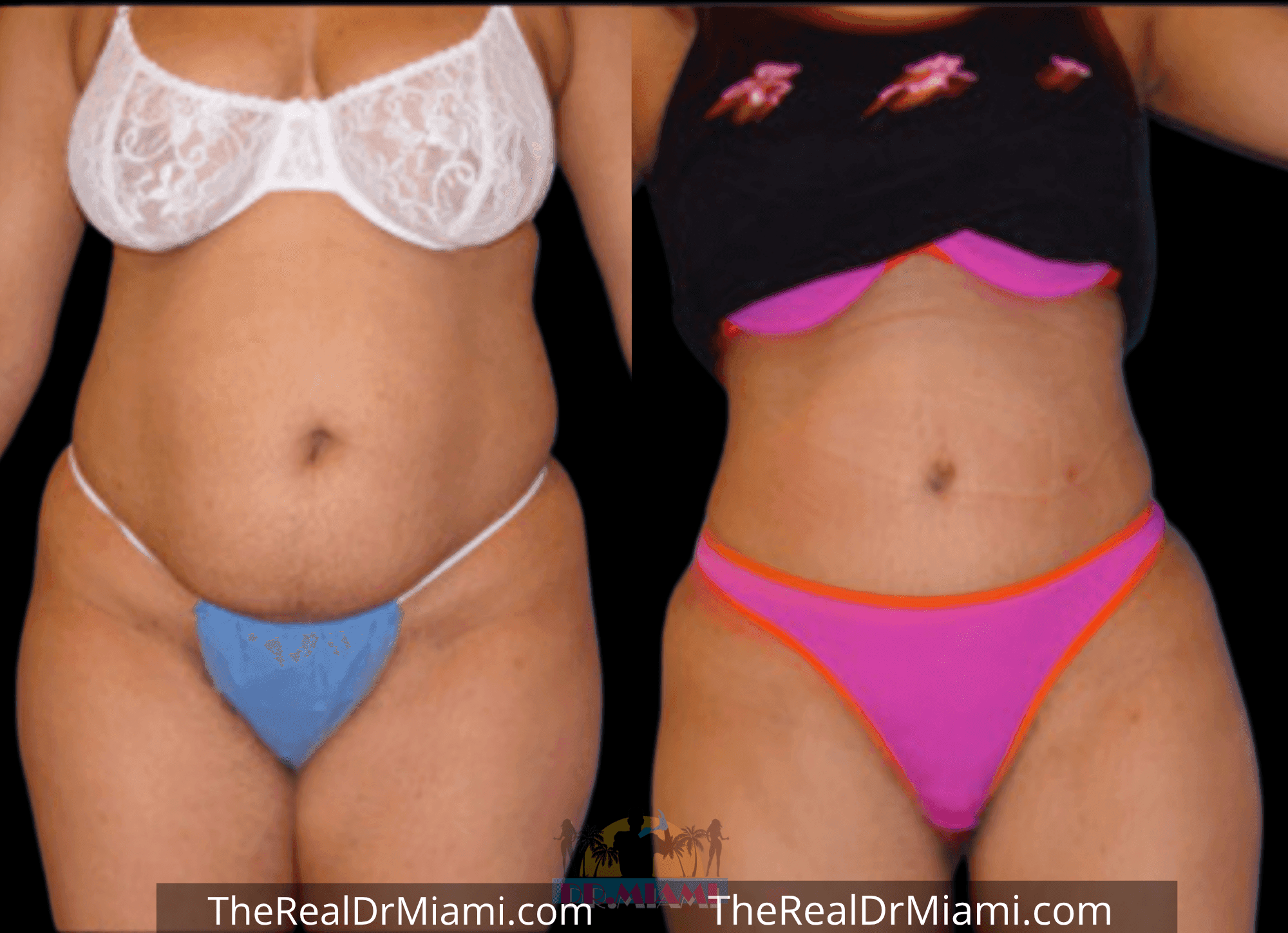 Before-and-after views for Tummy Tuck, Case 73.