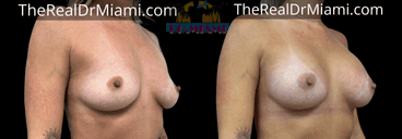 Before-and-after views for Breast Augmentation, Case 64.
