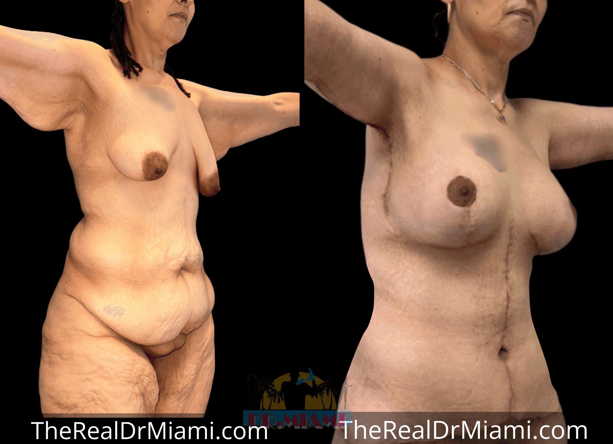 Before-and-after views for Massive Weight Loss, Case 40.