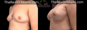 Before-and-after views for Breast Augmentation, Case 79.