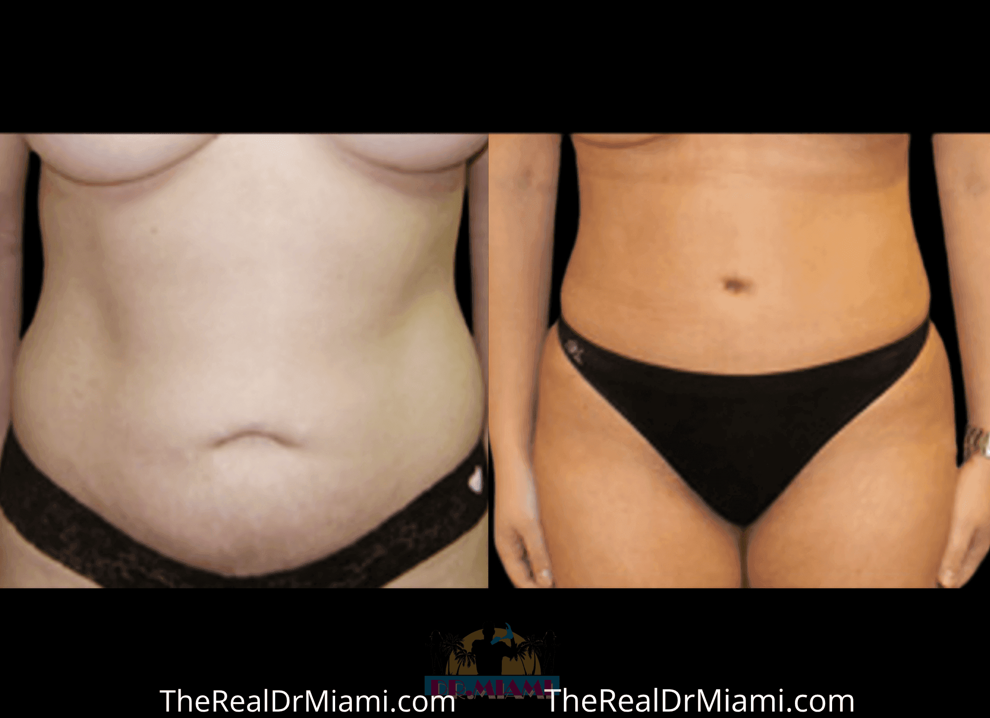 Before-and-after views for Tummy Tuck, Case 84.