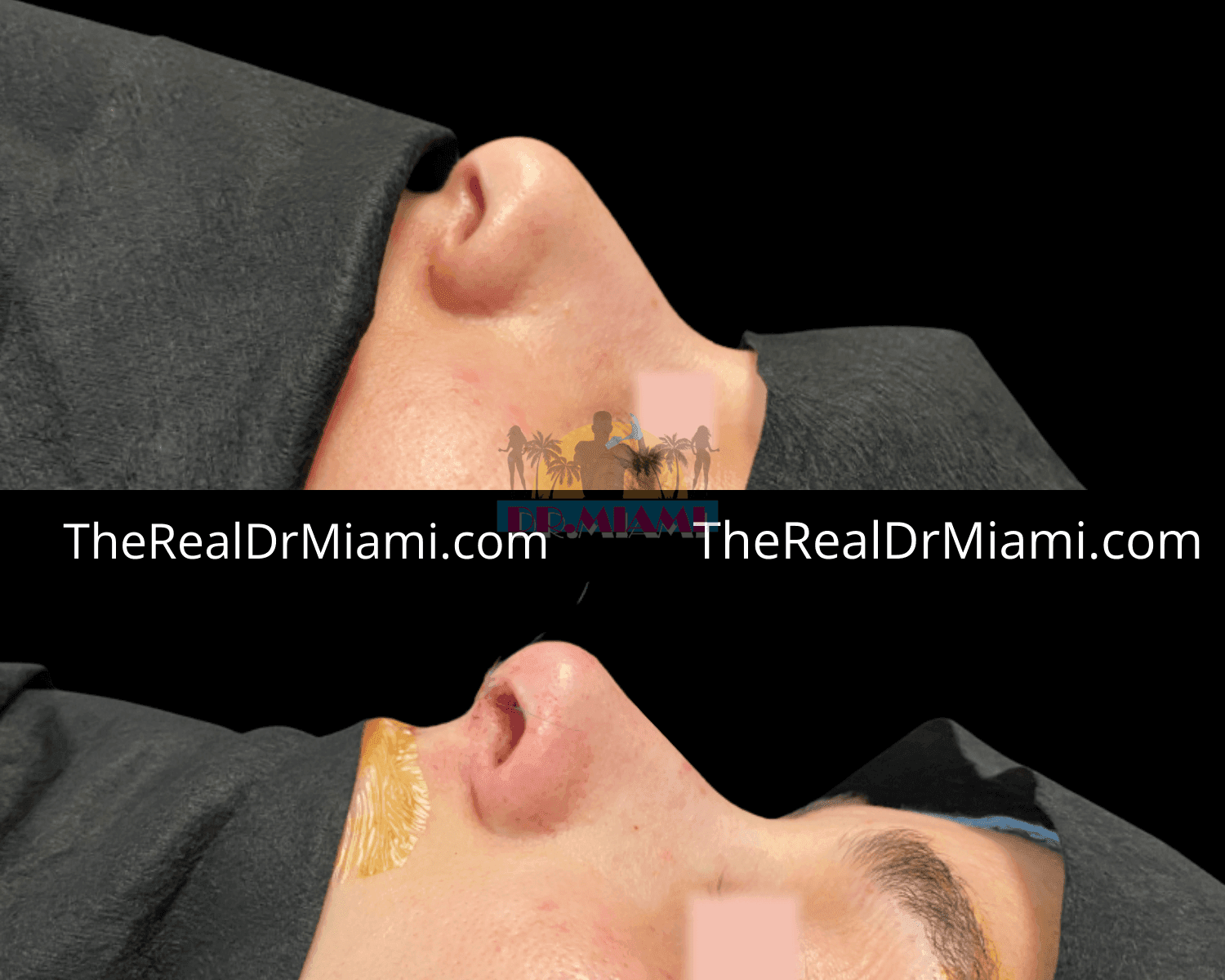 Before-and-after views for Rhinoplasty, Case 2.