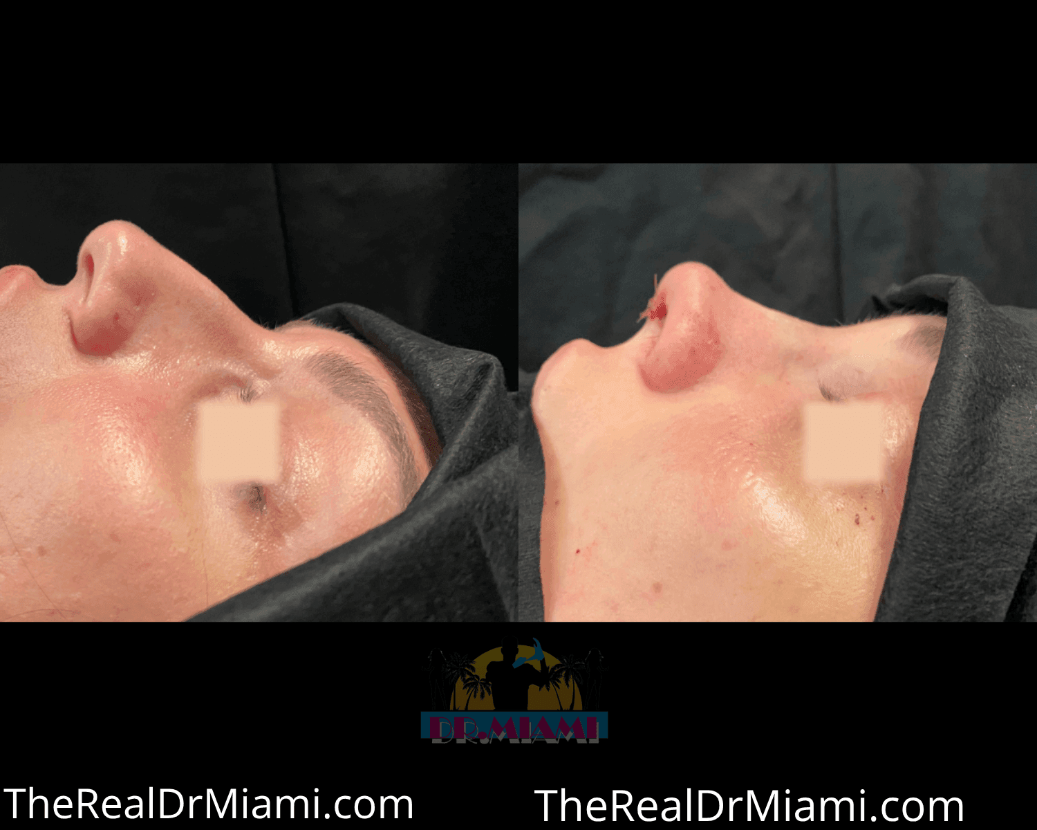 Before-and-after views for Rhinoplasty, Case 34.