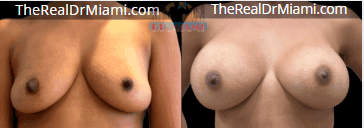 Before-and-after views for Breast Augmentation, Case 15.