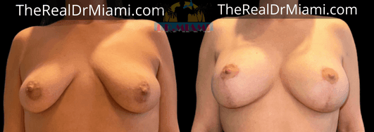 Before-and-after views for Breast Lift, Case 12.