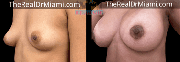 Before-and-after views for Breast Augmentation, Case 70.