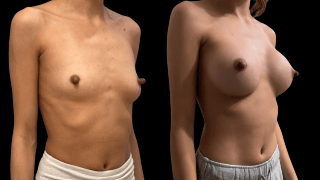 Before-and-after views for Breast Augmentation / Lift, Case 11 from The Next Dr. Miami collection.
