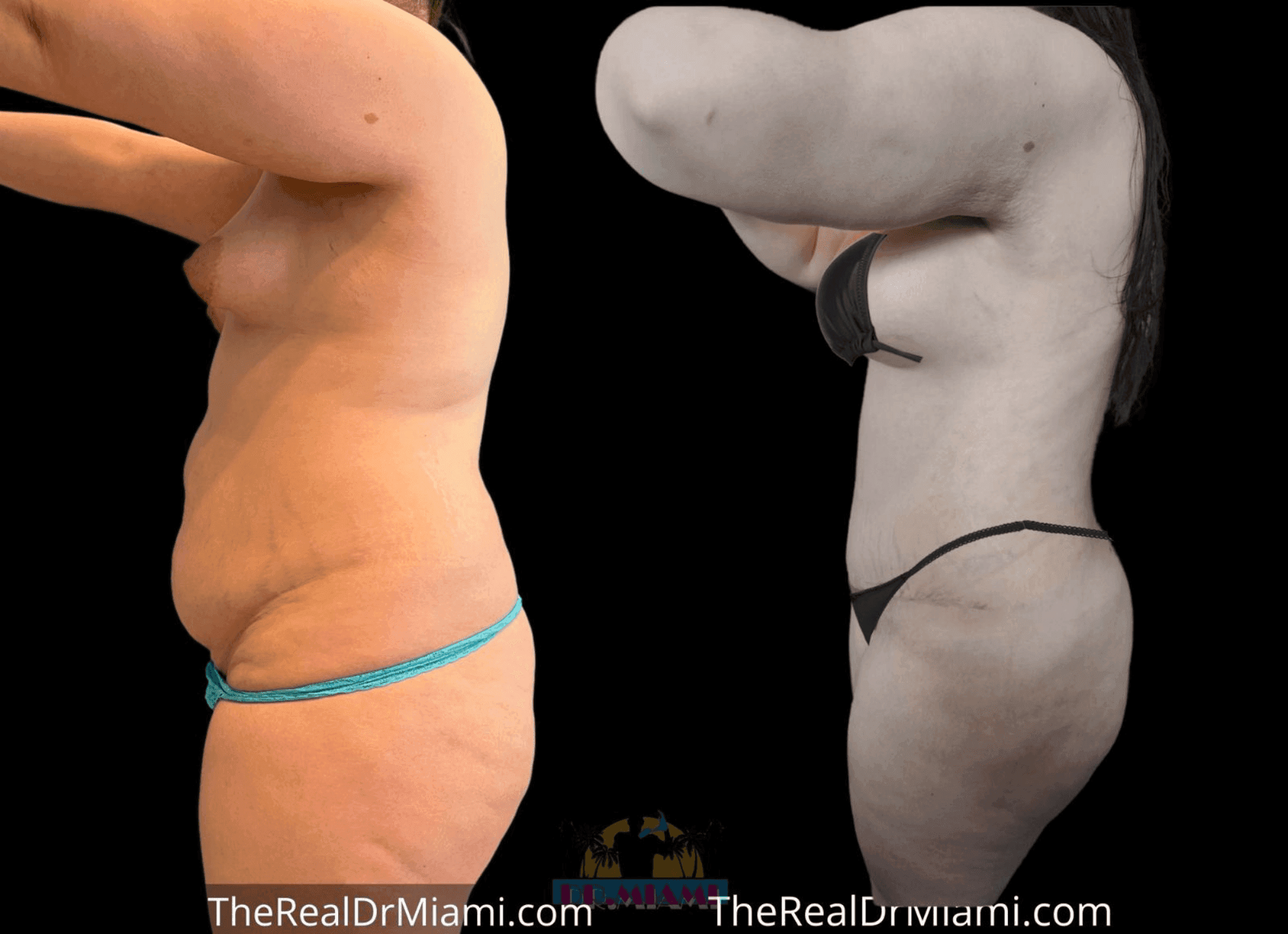 Before-and-after views for Mommy Makeover, Case 33.