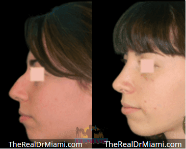 Before-and-after views for Rhinoplasty, Case 67.