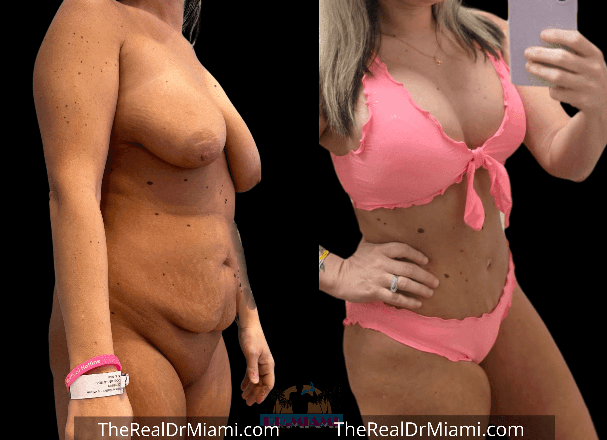 Before-and-after views for Mommy Makeover, Case 106.