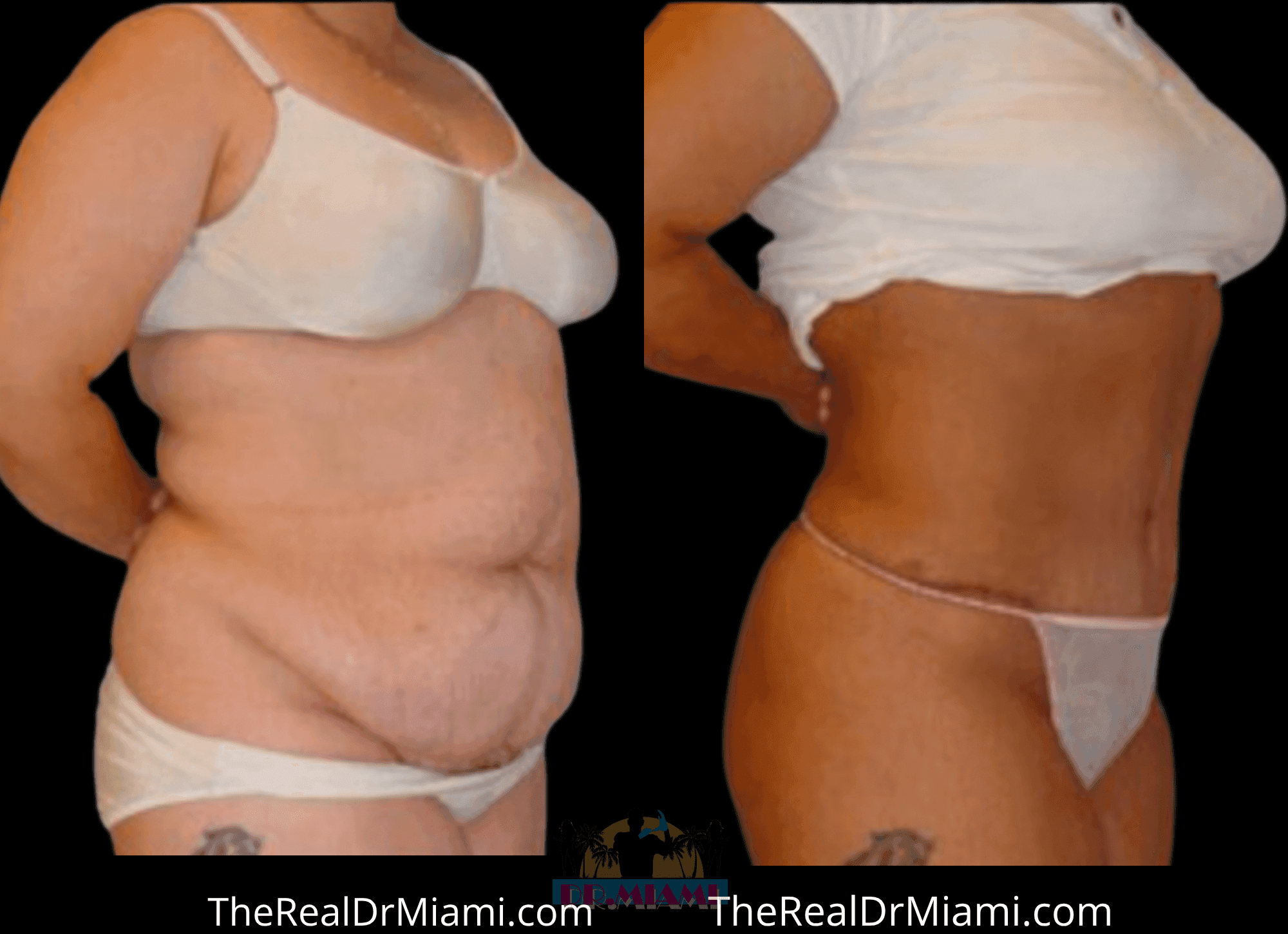 Before-and-after views for Tummy Tuck, Case 2.