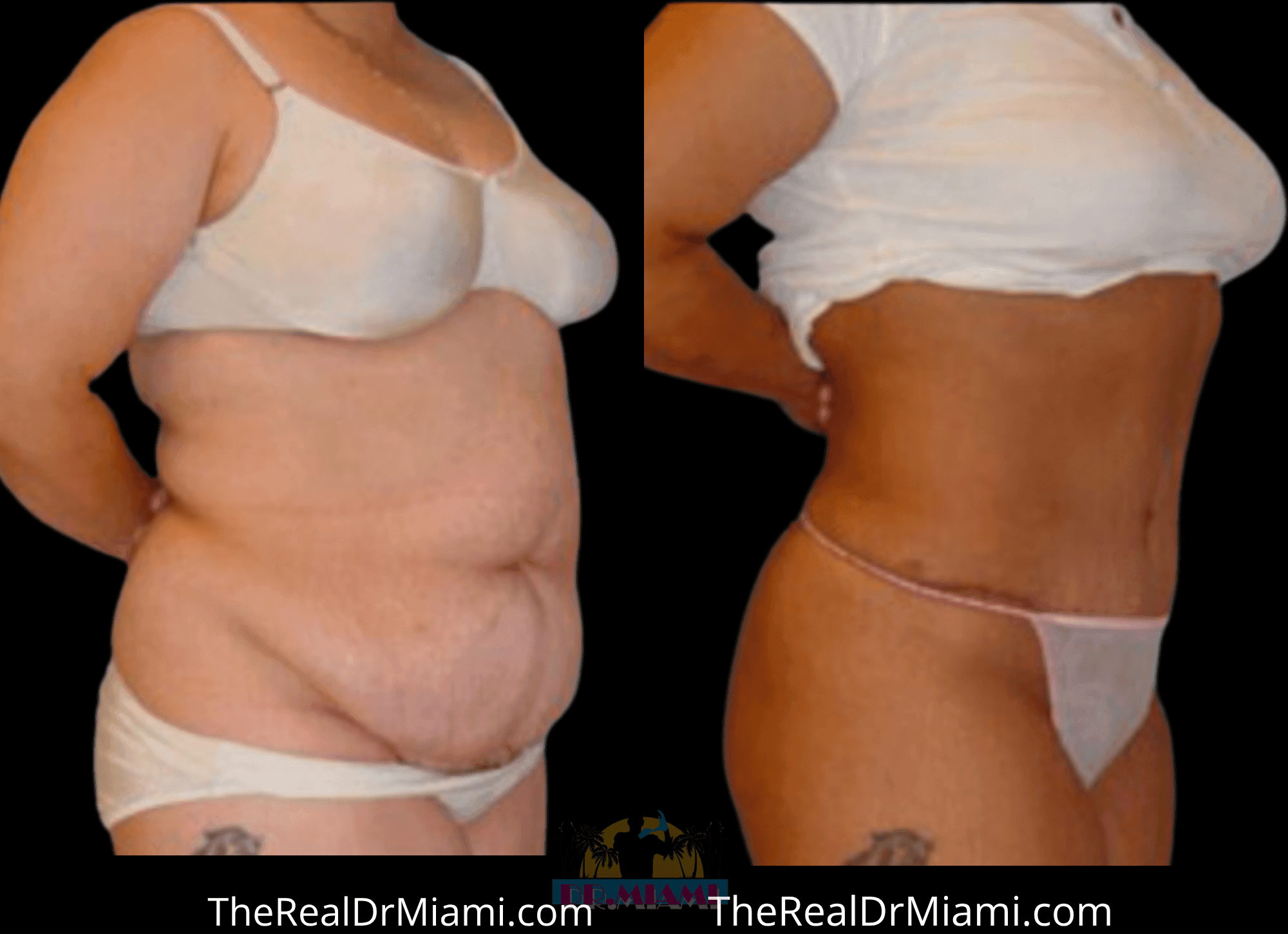 Before-and-after views for Tummy Tuck, Case 2.