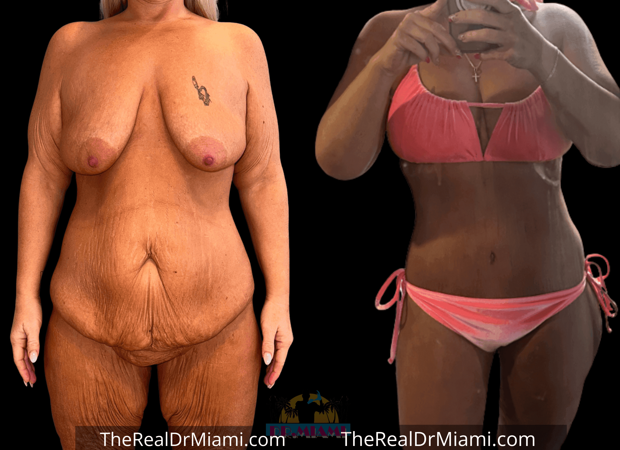 Before-and-after views for Mommy Makeover, Case 115.