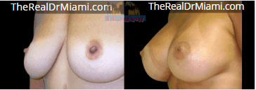 Before-and-after views for Breast Augmentation, Case 63.