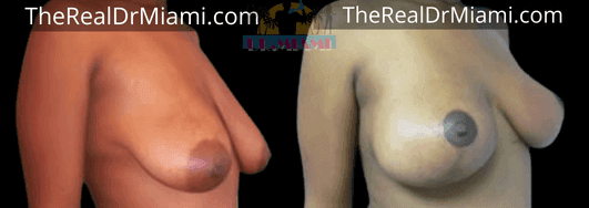 Before-and-after views for Breast Lift, Case 20.