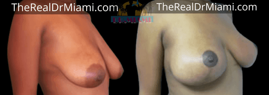 Before-and-after views for Breast Lift, Case 20.