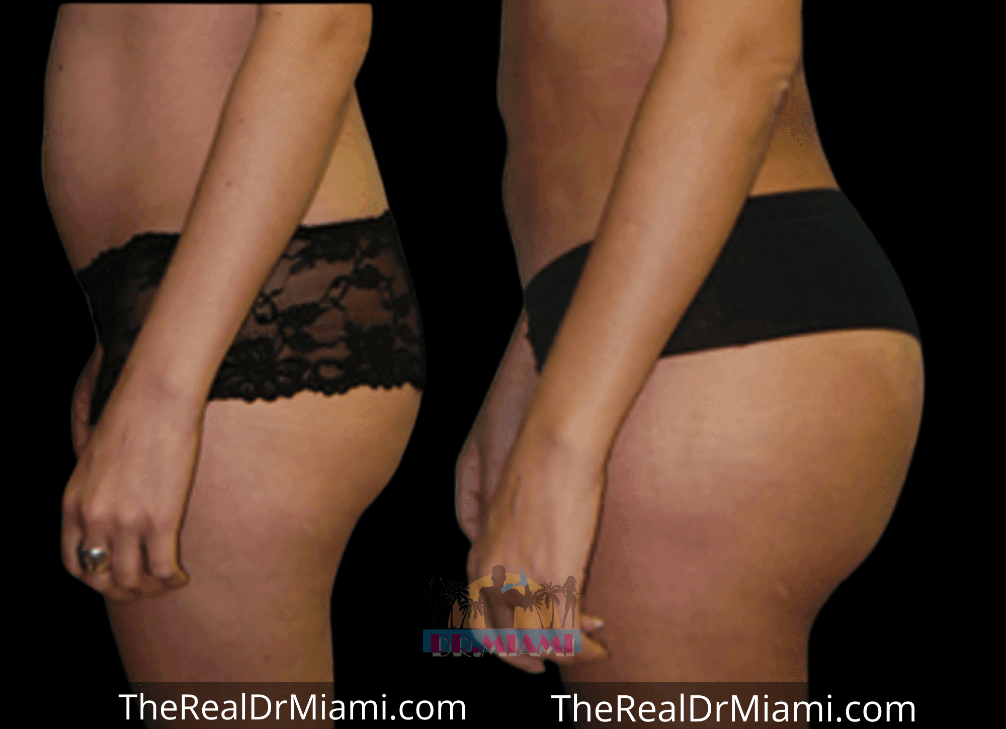 Before-and-after views for Brazilian Butt Lift, Case 73.
