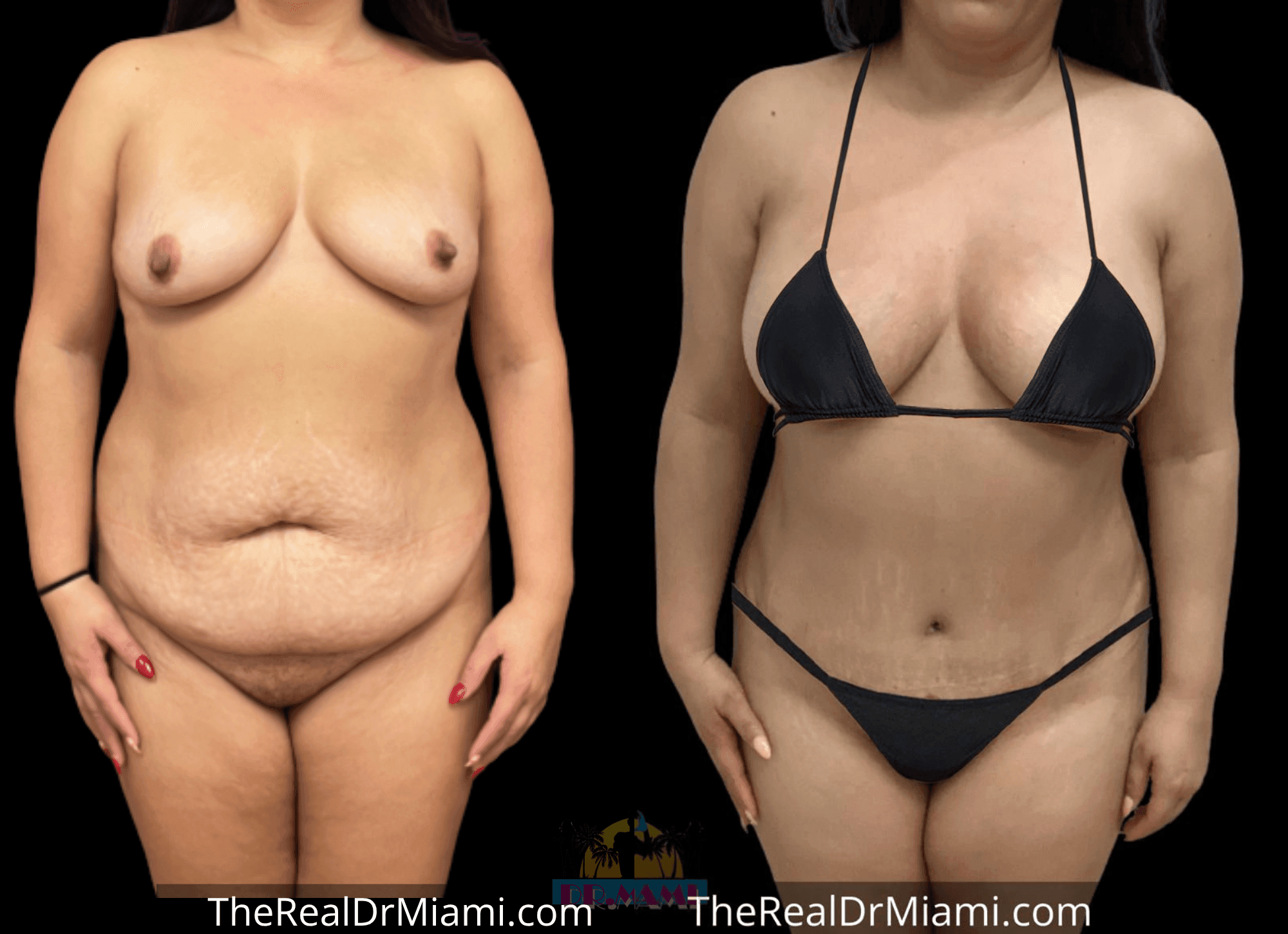 Before-and-after views for Tummy Tuck, Case 18.