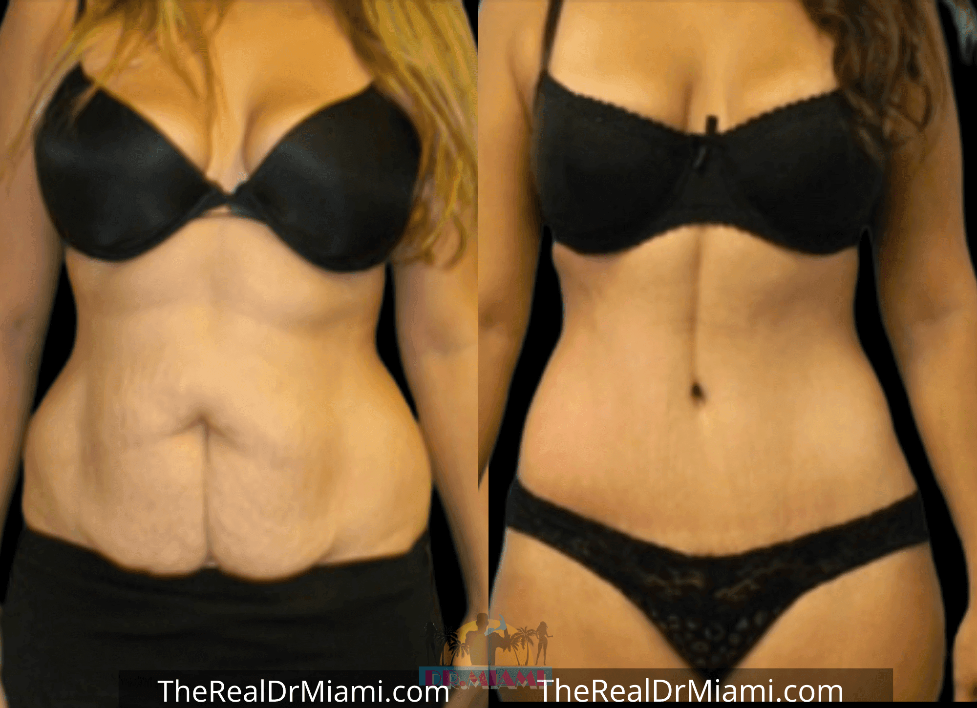Before-and-after views for Tummy Tuck, Case 65.